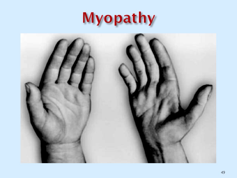 Myopathy 49